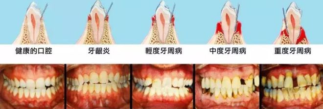 一、關(guān)于牙周病患者腦卒中可能性大增的爆款標(biāo)題