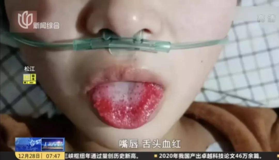 女子沒感冒一直流鼻涕竟是腦脊液