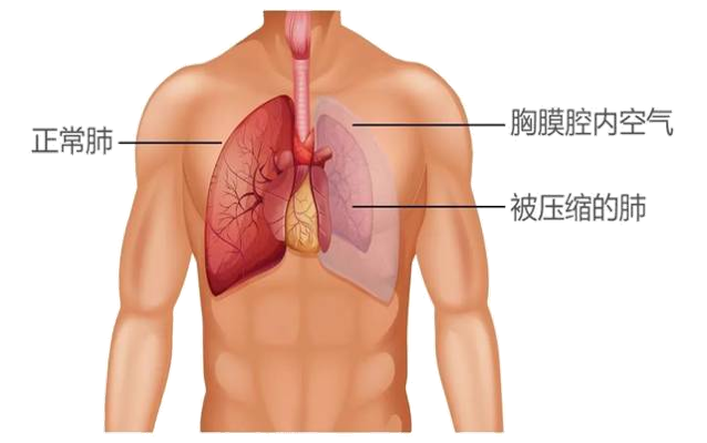 氣胸揭秘，癥狀、成因與防治，澳門視角深度解讀！