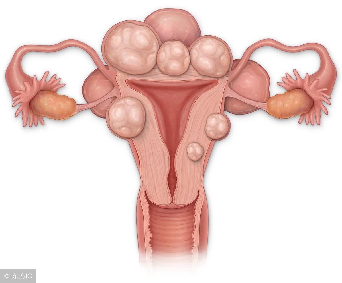 女子腹中驚現(xiàn)42顆子宮肌瘤！醫(yī)生揭秘手術背后的驚人真相！