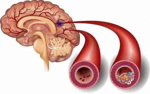 女教師突發(fā)腦梗背后的筋膜槍隱患揭秘